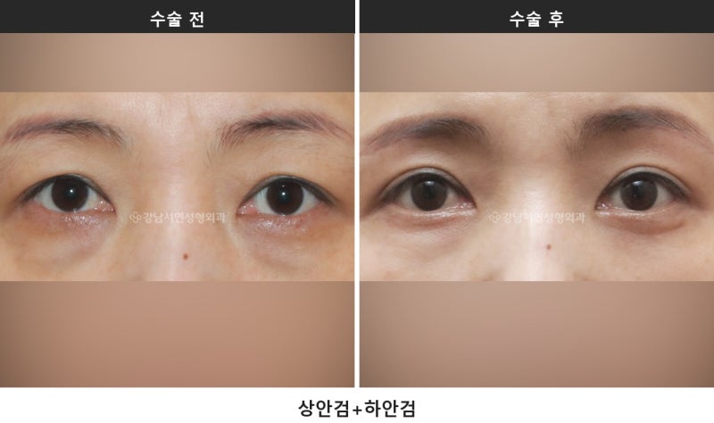 중년 눈성형, 눈이 처져 보이는 원인은 네 가지로 나뉩니다