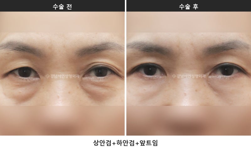 하안검과 눈밑지방재배치 차이, 피부 처짐 여부로 방법이 갈립니다_1탄 사진 2