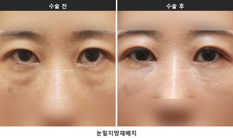 하안검과 눈밑지방재배치 차이, 피부 처짐 여부로 방법이 갈립니다_1탄