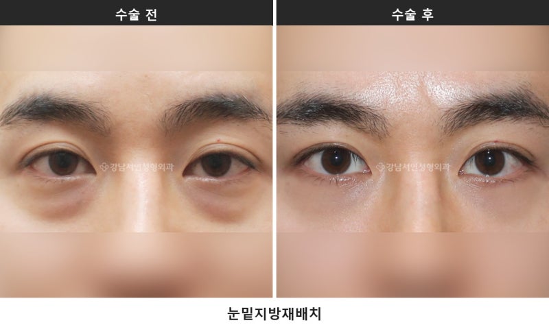 하안검과 눈밑지방재배치 차이, 피부 처짐 여부로 방법이 갈립니다_1탄 사진 3
