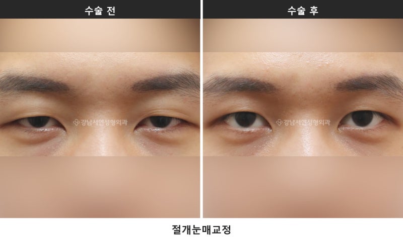 안검하수 뜻과 자가진단, 눈동자 중심에서 눈꺼풀까지 4~5mm가 기준입니다_1탄 사진 3