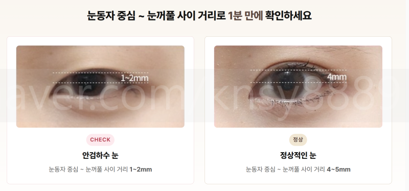 안검하수 뜻과 자가진단, 눈동자 중심에서 눈꺼풀까지 4~5mm가 기준입니다_1탄 사진 2