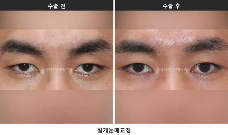 안검하수 뜻과 자가진단, 눈동자 중심에서 눈꺼풀까지 4~5mm가 기준입니다_1탄
