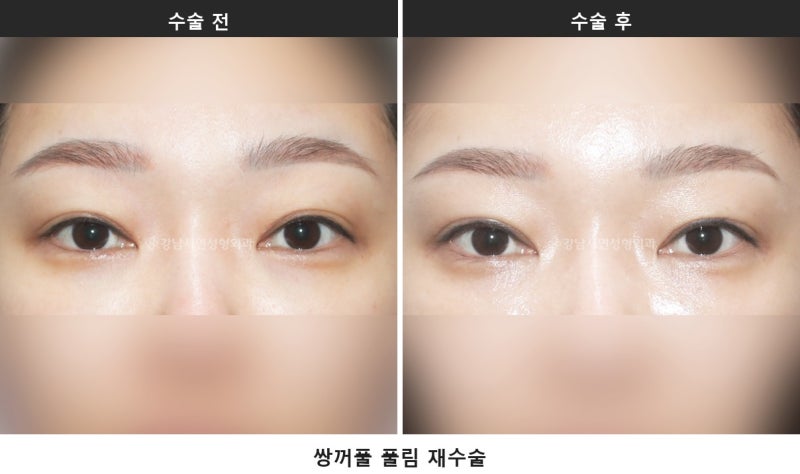 쌍수 상담 질문 리스트, 상담 전에 이것부터 확인해 보세요 사진 5