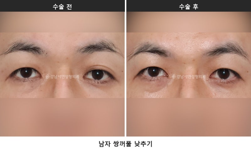 쌍수 상담 질문 리스트, 상담 전에 이것부터 확인해 보세요 사진 3
