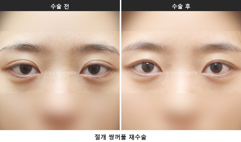 쌍수 상담 질문 리스트, 상담 전에 이것부터 확인해 보세요