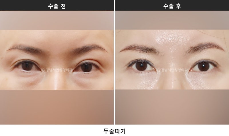 쌍수 상담 질문 리스트, 상담 전에 이것부터 확인해 보세요 사진 4