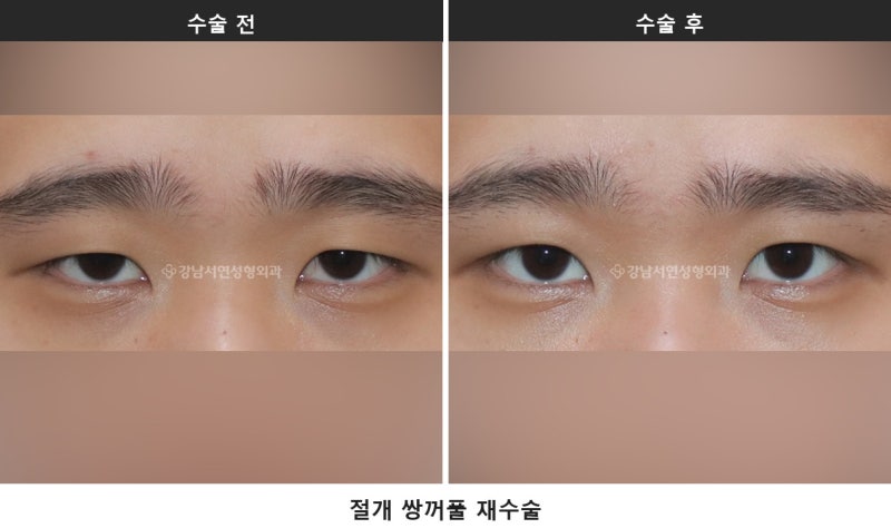 쌍수 상담 질문 리스트, 상담 전에 이것부터 확인해 보세요 사진 2