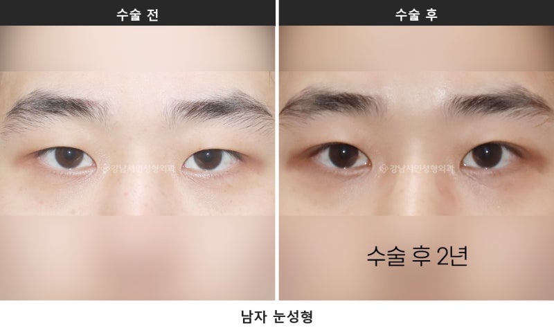 남자 눈성형이 여자와 다른 이유, 무쌍 눈매교정과 쌍꺼풀 낮추기_1탄