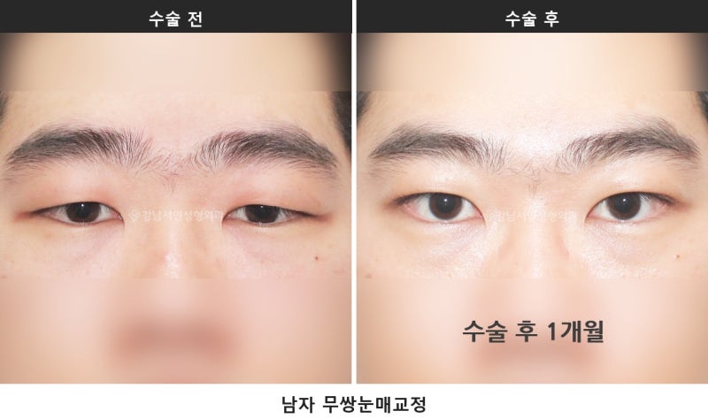 남자 눈성형이 여자와 다른 이유, 무쌍 눈매교정과 쌍꺼풀 낮추기_1탄 사진 2