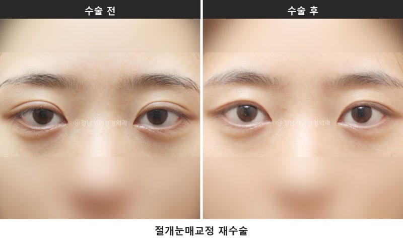 안검하수 뜻과 자가진단, 눈동자 중심에서 눈꺼풀까지 4~5mm가 기준입니다_2탄