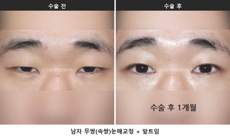 남자 눈성형이 여자와 다른 이유, 무쌍 눈매교정과 쌍꺼풀 낮추기_2탄