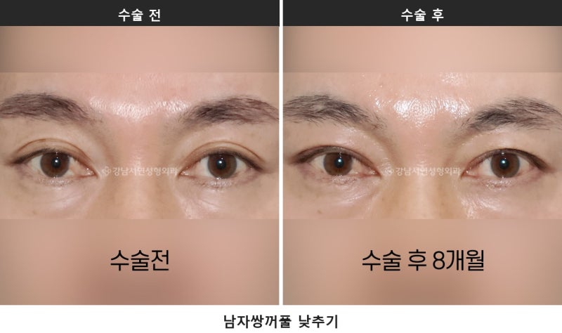 남자 눈성형이 여자와 다른 이유, 무쌍 눈매교정과 쌍꺼풀 낮추기_2탄 사진 3
