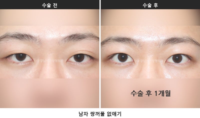 남자 눈성형이 여자와 다른 이유, 무쌍 눈매교정과 쌍꺼풀 낮추기_2탄 사진 2